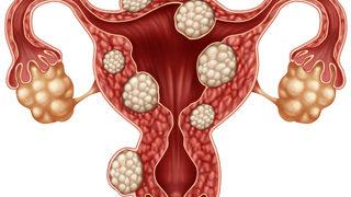 V-Notes yöntemi miyom tedavisi ameliyatında izsiz ve ağrısız sonuç almayı sağlıyor