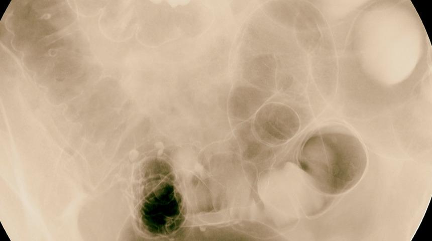 Crohn ve Kolit belirtileri neler? Pandemide bağışıklık baskılayıcı ilaçlar bırakılmalı mı?