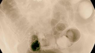 Crohn ve Kolit belirtileri neler? Pandemide bağışıklık baskılayıcı ilaçlar bırakılmalı mı?