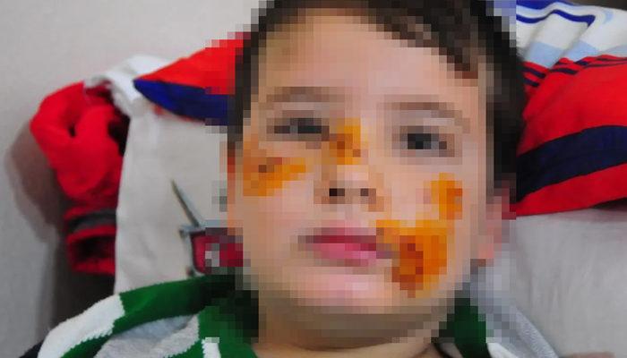 Ankara'dan sonra şimdi de Manisa! 8 yaşındaki Mert'in yüzüne 60 dikiş atıldı