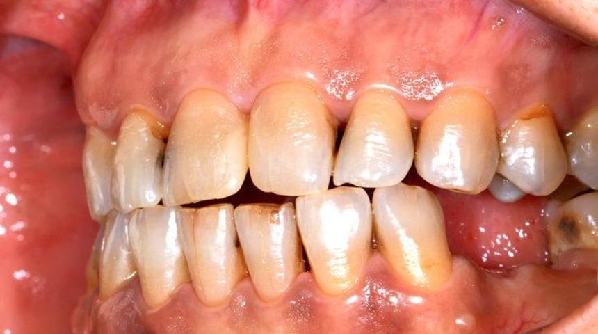 Önemsenmeyen risk: Ağız kanseri 