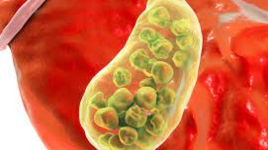 Safra kesesi taşları kansere neden oluyor