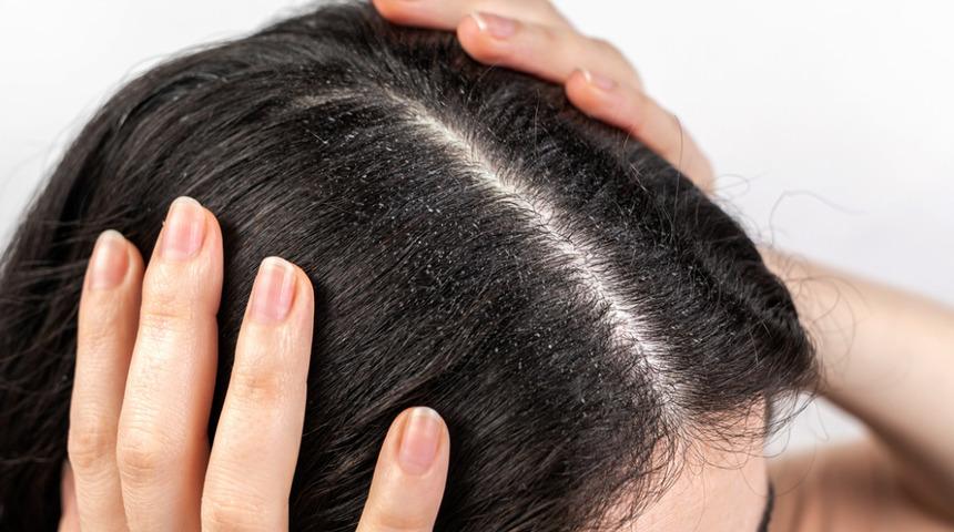 Kepek problemine pratik çözümler! Bu yöntemlerle kepek sorununuzu geride bırakacaksınız