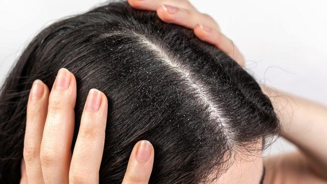 Kepek problemine pratik çözümler! Bu yöntemlerle kepek sorununuzu geride bırakacaksınız