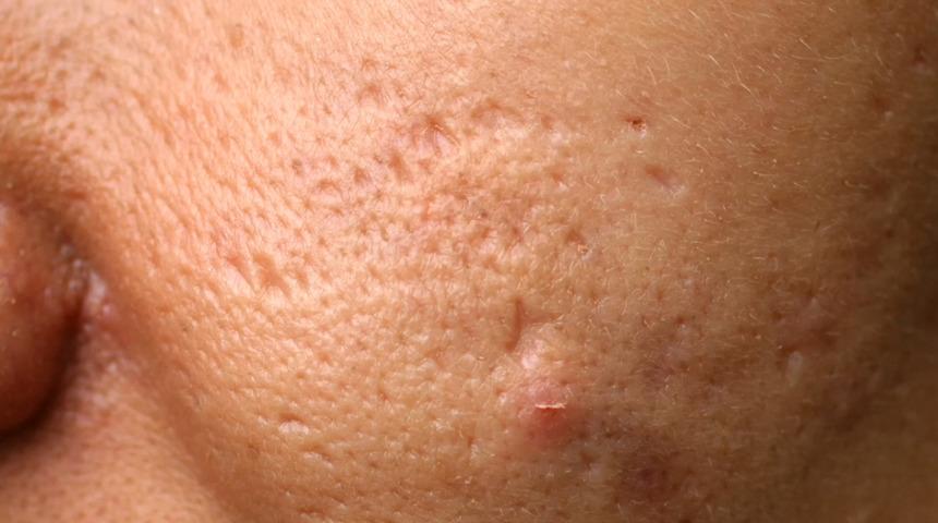 Sivilce izleri kâbusunuz olmasın! Bu yöntemleri kullanarak bebek gibi bir cilde sahip olabilirsiniz