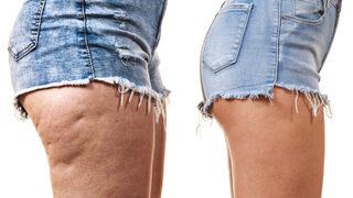 Selülitlerden kurtulmak için binlerce lira harcamanıza gerek yok! Bu yöntemler hepsiyle vedalaşmanızı sağlıyor