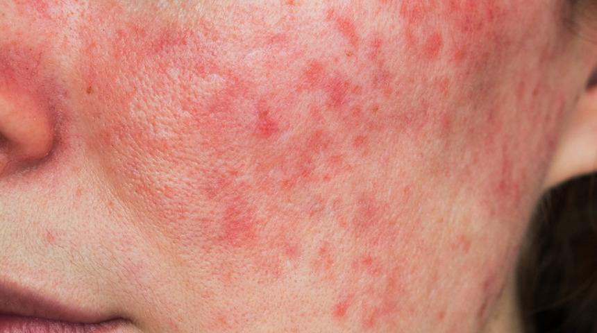 Eklem ağrılarına dikkat! Lupus olabilirsiniz