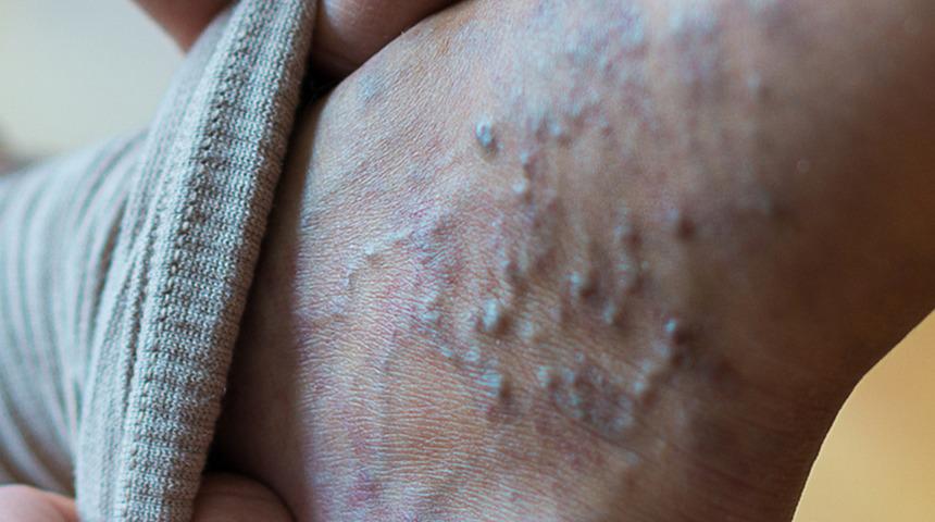 Ameliyatsız varis tedavisinde ayırmanız gereken zaman bir öğle molası kadar!