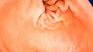 Kolon kanserinin erken evrede tespiti ile ameliyatsız tedavi mümkün! Terapötik endoskopi yöntemi nedir?