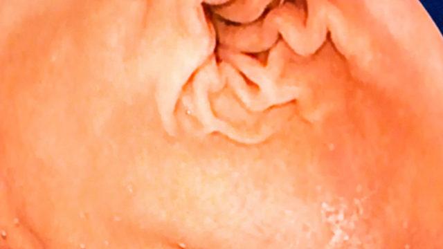 Kolon kanserinin erken evrede tespiti ile ameliyatsız tedavi mümkün! Terapötik endoskopi yöntemi nedir?