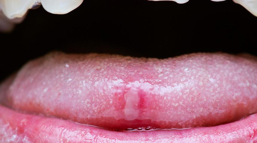 Ağız yaraları neden olur? Ciddiye almadığınız yaralar hayati öneme sahip olabilir