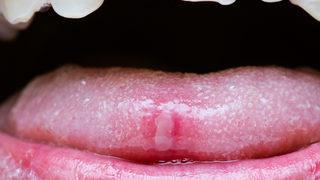 Ağız yaraları neden olur? Ciddiye almadığınız yaralar hayati öneme sahip olabilir