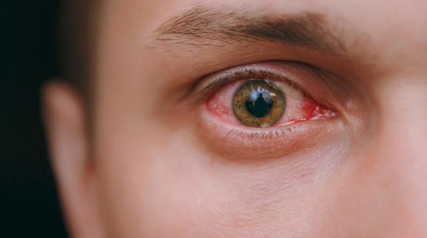 Göz nezlesinde bulaşma süresine dikkat! Görme kaybına bile neden oluyor