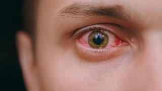 Göz nezlesinde bulaşma süresine dikkat! Görme kaybına bile neden oluyor