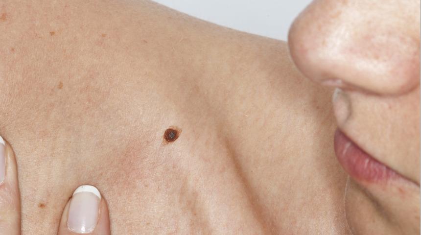 Vücudunuzdaki benlere dikkat! Şekilleri ve boyutları ipucu veriyor