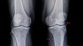 Diz kireçlenmesi neden olur, belirtileri ve tedavisi nedir?
