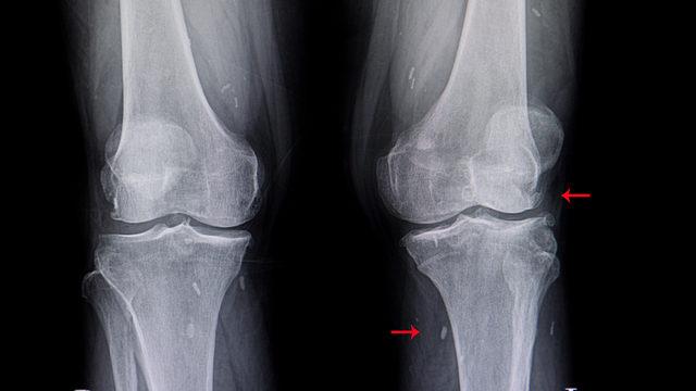 Diz kireçlenmesi neden olur, belirtileri ve tedavisi nedir?