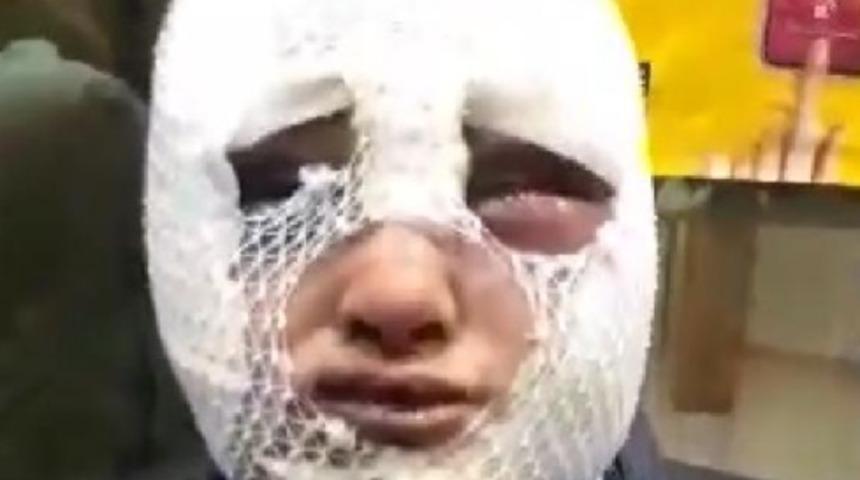 Hatay'da eski sözlü dehşeti! Cinsel saldırıda bulunup başından aşağı kızgın yağ döktü