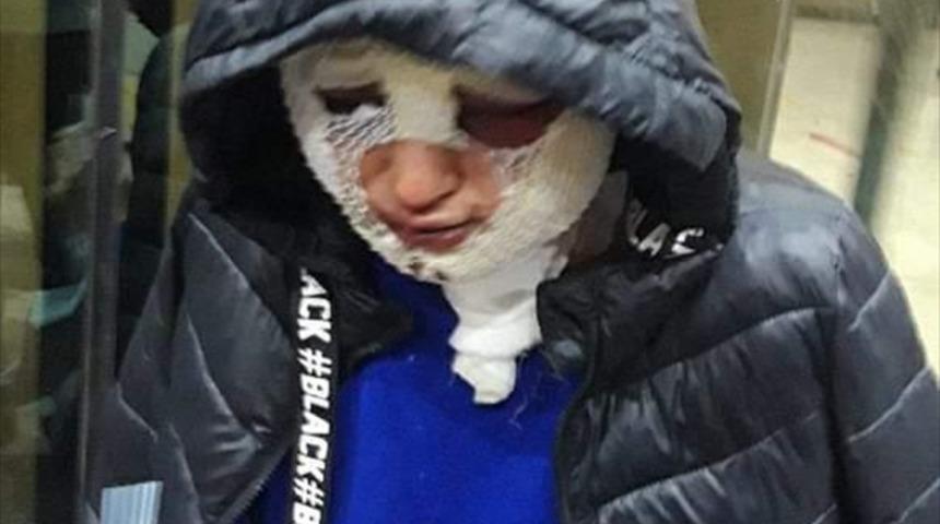 Hatay'da eski erkek arkadaşının yüzüne kızgın yağ döktüğü kadın yaralandı