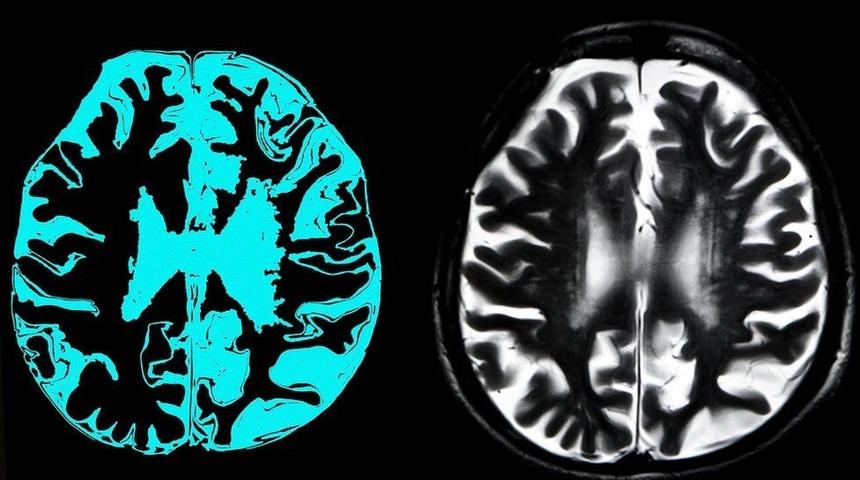 AB, Alzheimer tedavisi i&ccedil;in geliştirilen ilaca kullanım onayı vermedi