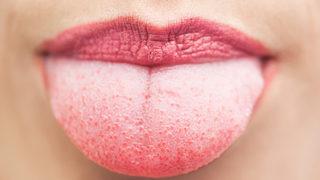 Dilinizde asla göz ardı etmemeniz gereken 5 uyarı işareti! Beyaz dilin nedeni bu olabilir