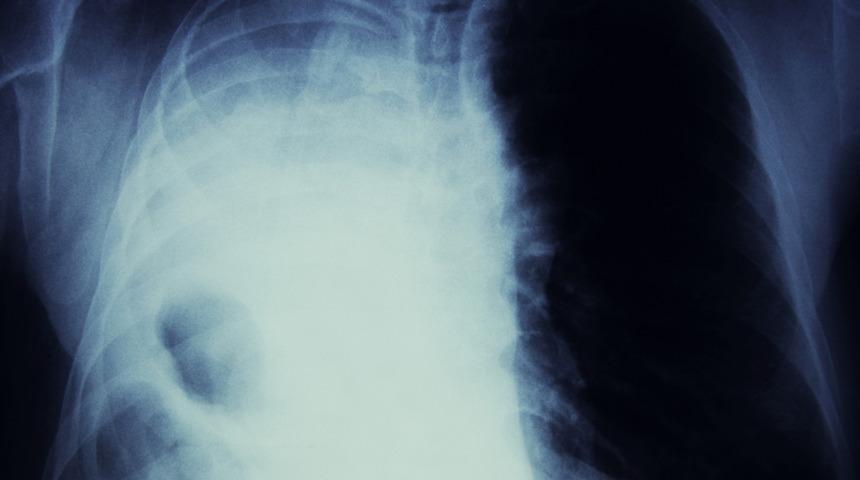 Akciğer kanseri neden olur? Bu hata riski 20 kat arttırıyor! Siz de risk grubundaysanız mutlaka...