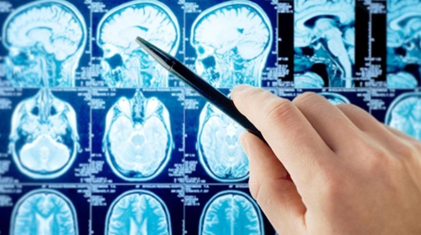 Son Dakika: ALS hastalığının çaresi bulundu! Alzheimer için geliştirilen ilaç ALS tedavisinde etkili