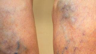 Gizli / iç varis belirtileri ve tedavisi nedir? 