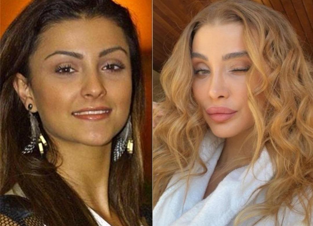 &Ouml;zge Ulusoy'dan estetik a&ccedil;ıklaması! "Hi&ccedil; korkmuyorum"