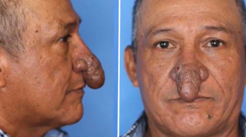 Burnu cinsel organa benzeyen adam sosyal medyada gündem yarattı! Estetik ameliyatla tamamen değişti