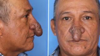 Burnu cinsel organa benzeyen adam sosyal medyada gündem yarattı! Estetik ameliyatla tamamen değişti