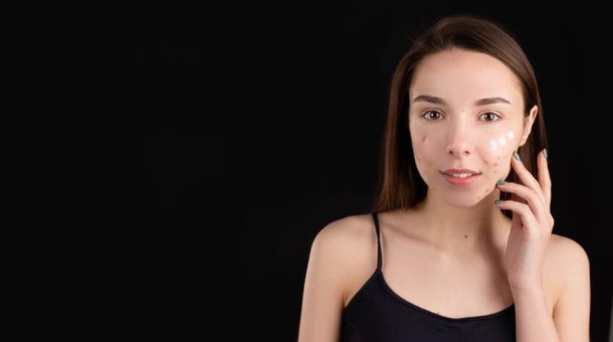 Sivilceler size dert olmasın! Sivilce izlerinize iyi gelecek doğal tarifler için sizi buraya alalım