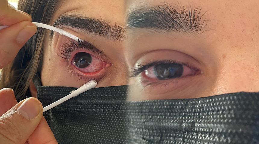 Son haftalarda vakalar arttı! Çok hızlı yayılıyor, görme kaybına bile yol açıyor