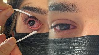 Son haftalarda vakalar arttı! Çok hızlı yayılıyor, görme kaybına bile yol açıyor