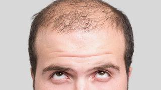 Saç ekimi uygulamasından sonra özel bir saç bakımı gerekli mi?