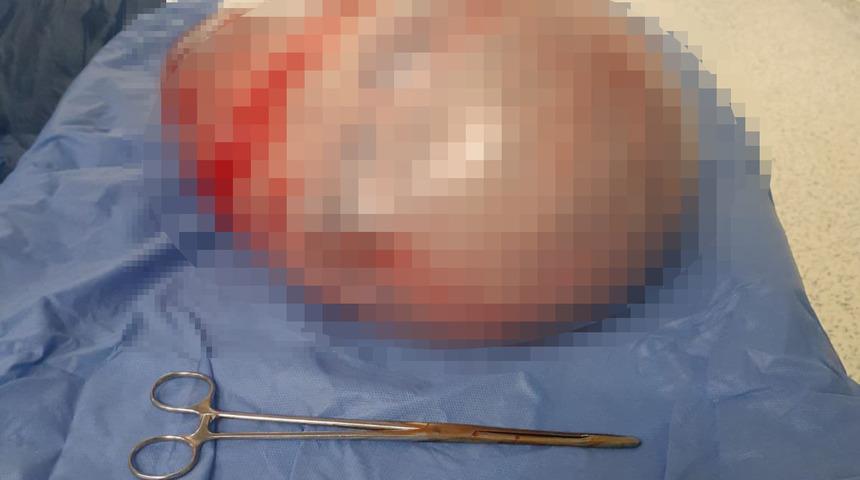 Karın şişliği şikayetiyle hastaneye gitti, karnından 9 kilo tümör çıktı