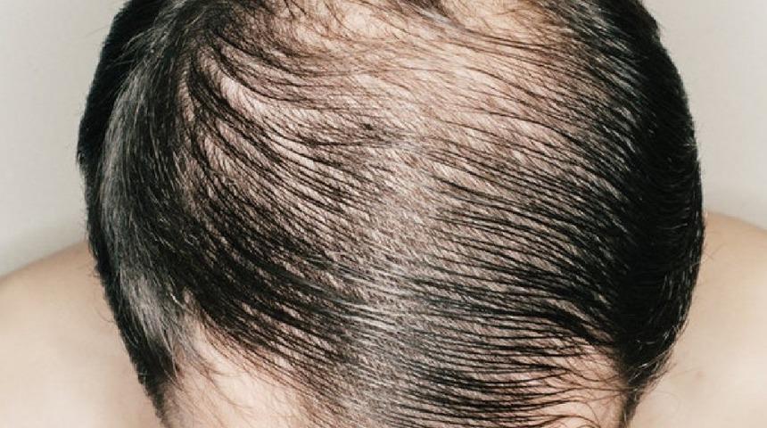 Kel kalmak sorun olmaktan çıkıyor! İşte doğal çaresi