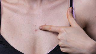 Cilt lekesi deyip geçmeyin! Esmerler ekstra dikkat etmeli