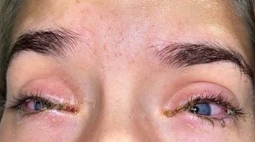 Bir haftada bu hale geldi! Takma kirpikler gözlerinden ediyordu