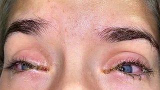 Bir haftada bu hale geldi! Takma kirpikler gözlerinden ediyordu