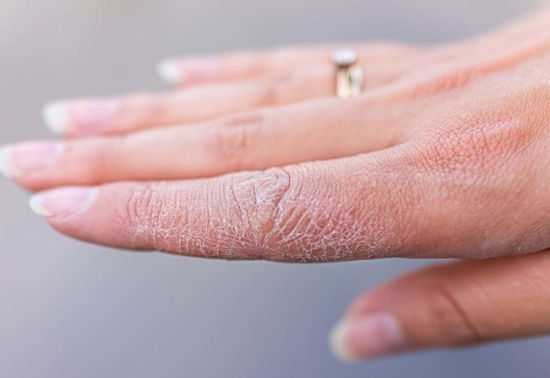 &Ouml;nlem almazsanız egzamaya d&ouml;n&uuml;şebilir! Cildiniz pul pul d&ouml;k&uuml;l&uuml;yorsa&hellip;