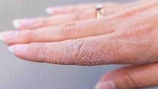 Önlem almazsanız egzamaya dönüşebilir! Cildiniz pul pul dökülüyorsa…