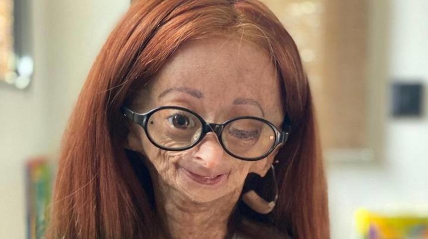 Youtuber Adalia Rose Williams, 15 yaşında hayatını kaybetti! Sevenlerini üzen haberi ailesi verdi