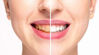 Dişlerinizi bembeyaz yapmak o kadar kolay ki... Sadece 3 şeye ihtiyacınız var