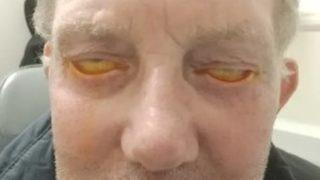 Başarısız estetik operasyondan sonra hayatı mahvoldu! 3 yıl boyunca gözlerini kapatamadı, çareyi Türkiye’de buldu