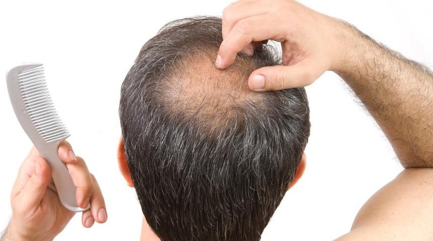 Saç dökülmesinden nasıl kurtulabilirsiniz? Saç dökülmesinin nedenleri ve çözümleri