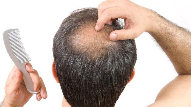 Saç dökülmesinden nasıl kurtulabilirsiniz? Saç dökülmesinin nedenleri ve çözümleri