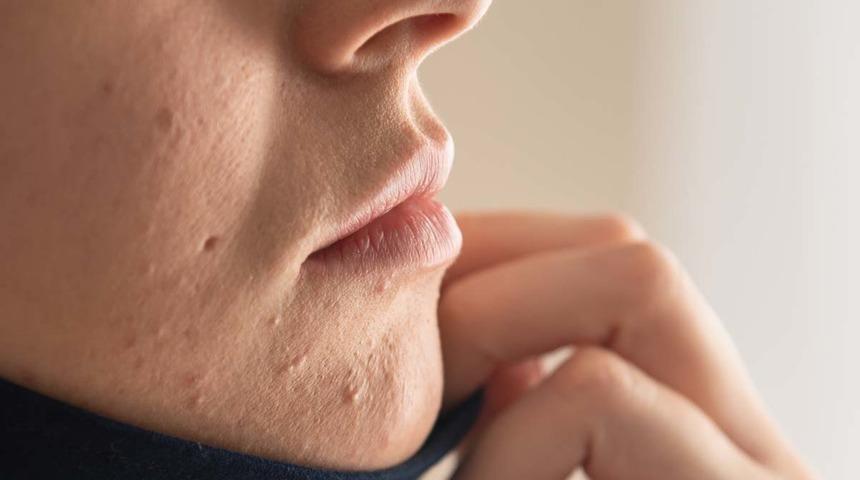 Listeye virüs giremedi! Türkiye’nin yarısı cilt hastalıklarını aradı