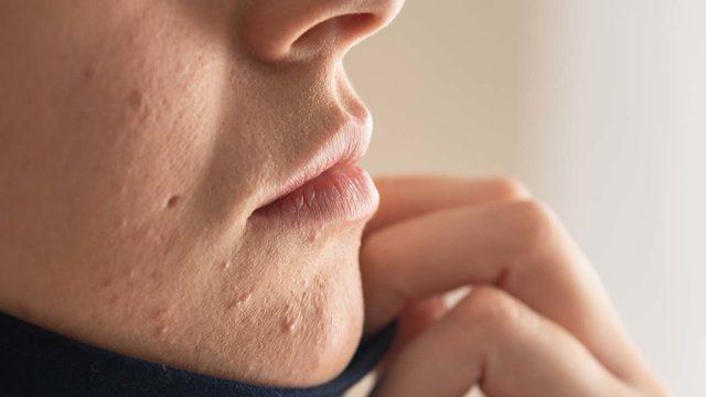 Listeye virüs giremedi! Türkiye’nin yarısı cilt hastalıklarını aradı