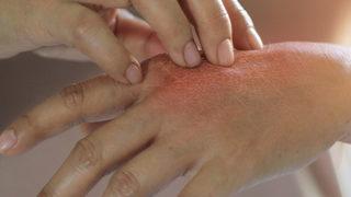 Ne yapsam bir türlü geçmiyor diyenler için egzamaya karşı etkili ve doğal çözüm önerileri!